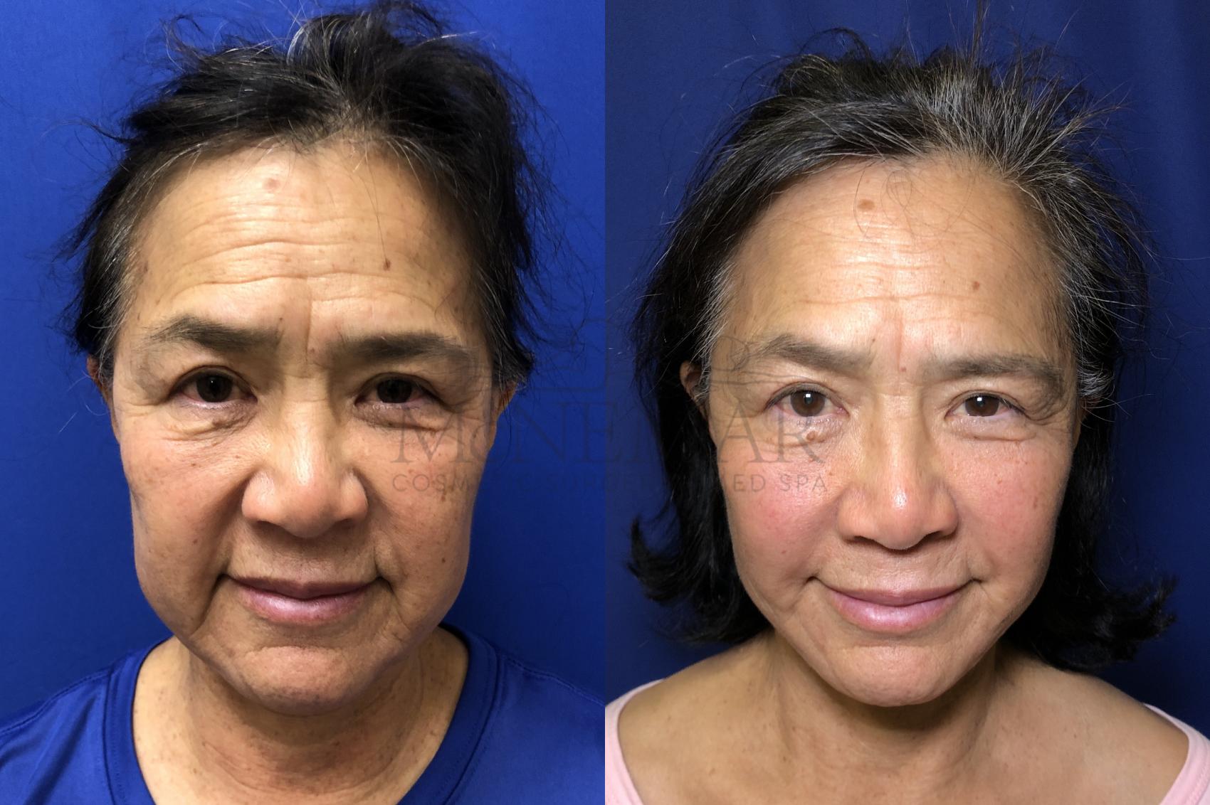 Facelift Case 174 Before & After Front | Tracy, Brentwood & Livermore, CA | McNemar Cosmetic Surgery