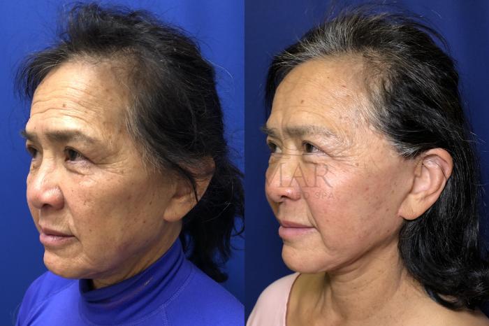 Facelift Case 174 Before & After Left Side | Tracy, Brentwood & Livermore, CA | McNemar Cosmetic Surgery