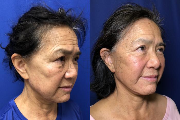 Facelift Case 174 Before & After Right Oblique | Tracy, Brentwood & Livermore, CA | McNemar Cosmetic Surgery