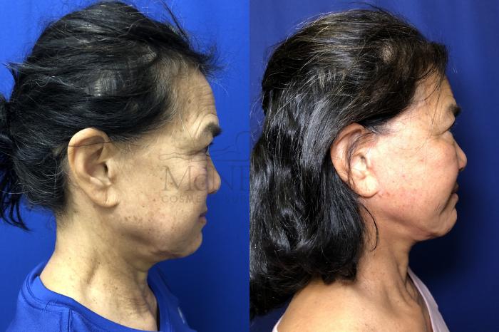 Facelift Case 174 Before & After Right Side | Tracy, Brentwood & Livermore, CA | McNemar Cosmetic Surgery