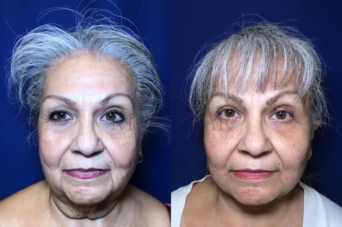 Facelift Case 205 Before & After Front | Tracy, Brentwood & Livermore, CA | McNemar Cosmetic Surgery