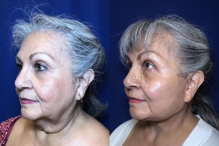 Facelift Case 205 Before & After Left Oblique | Tracy, Brentwood & Livermore, CA | McNemar Cosmetic Surgery