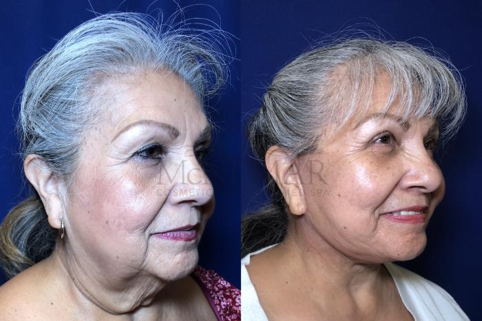 Facelift Case 205 Before & After Right Oblique | Tracy, Brentwood & Livermore, CA | McNemar Cosmetic Surgery