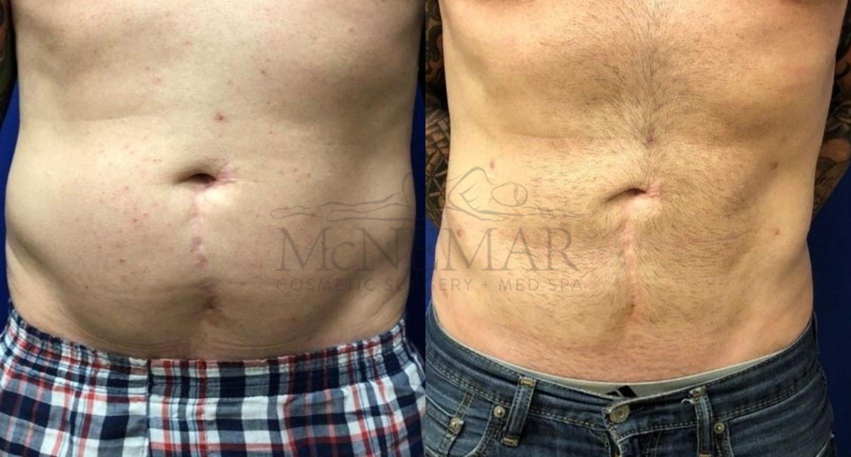 Liposuction Case 118 Before & After Front | San Ramon & Tracy, CA | McNemar Cosmetic Surgery