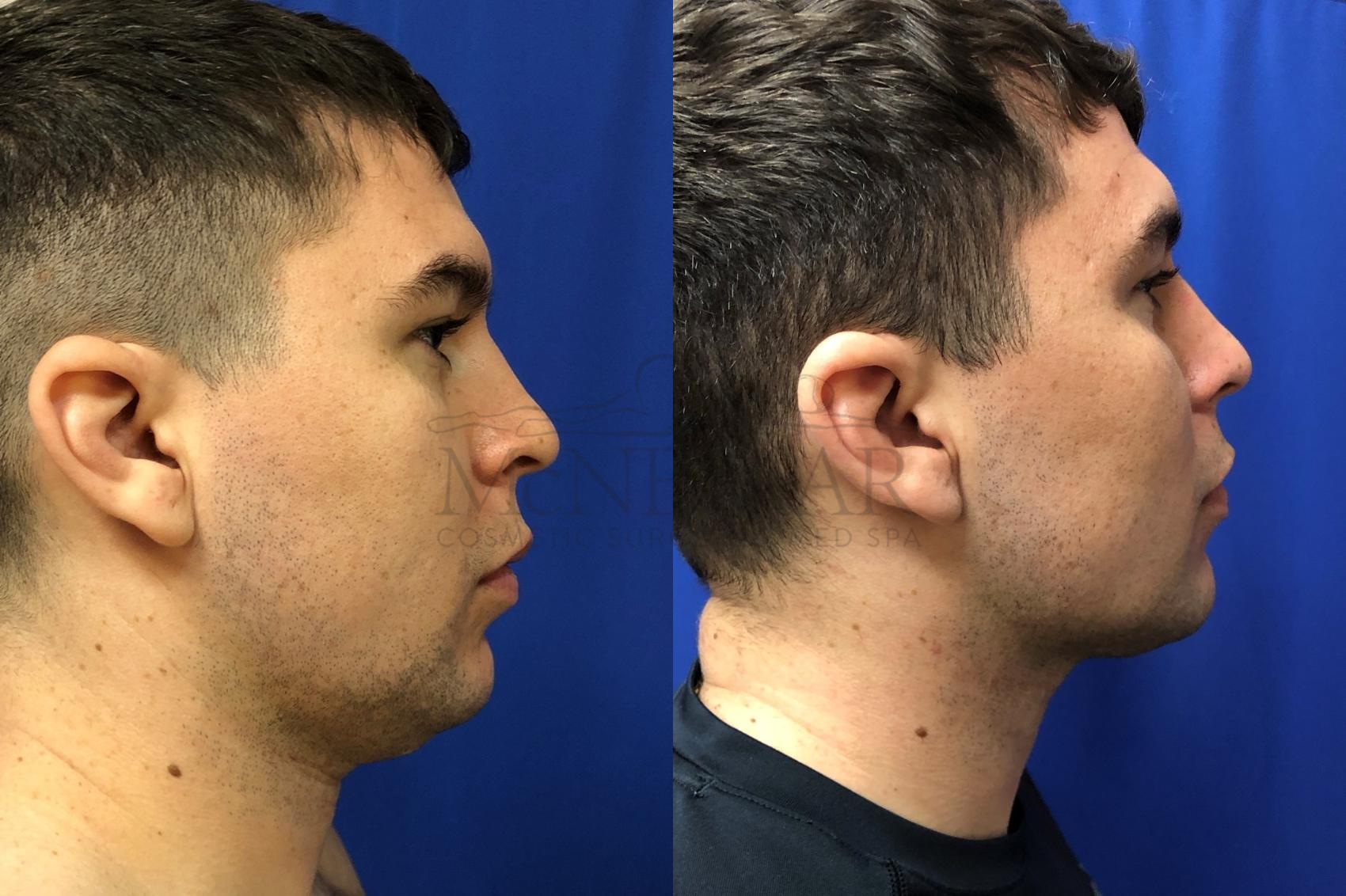 Liposuction for a 30 year old male. 