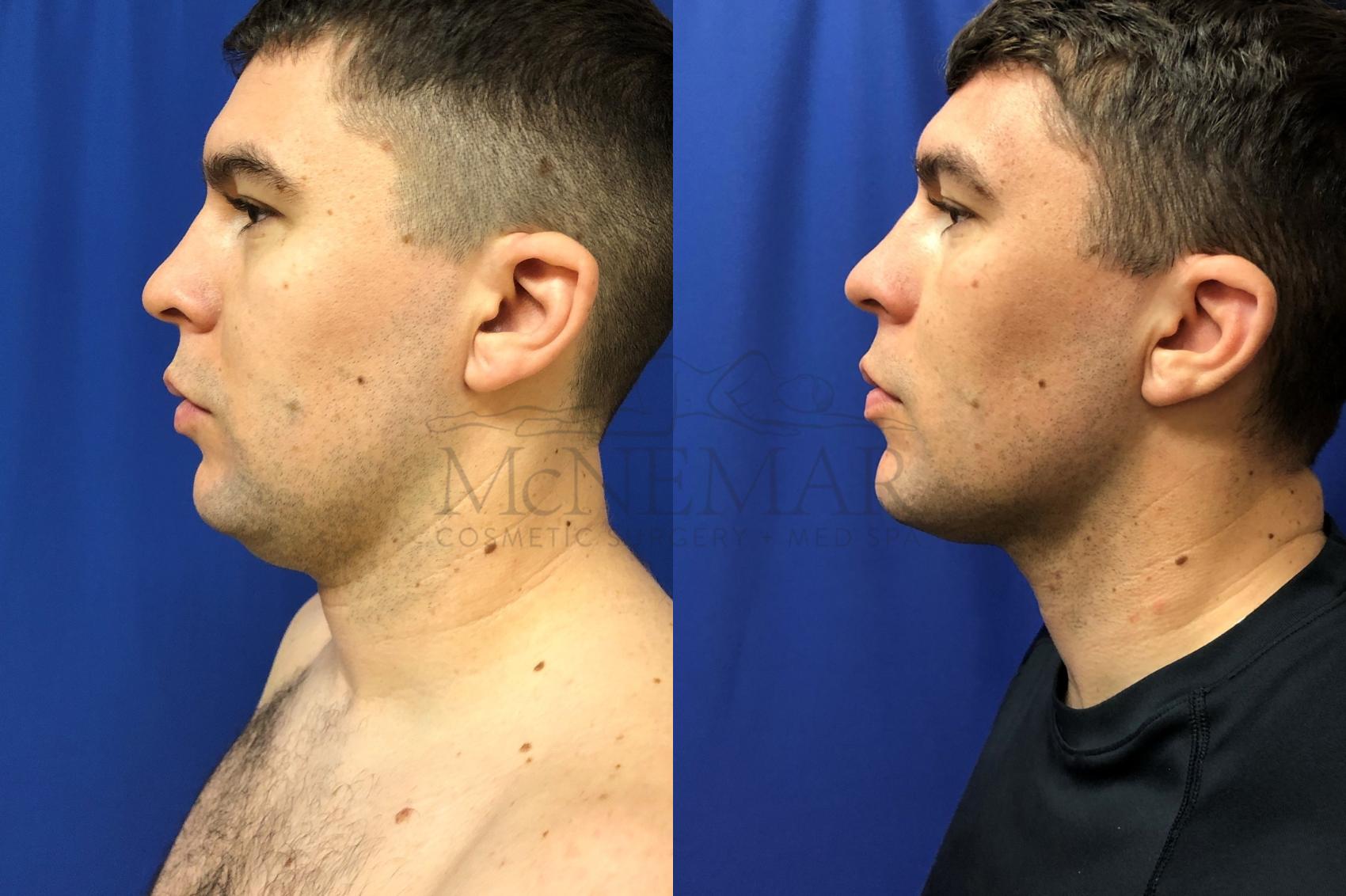 Liposuction for a 30 year old male. 