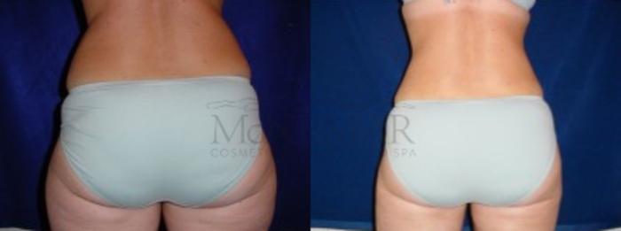Liposuction Case 13 Before & After View #3 | Tracy, Brentwood & Livermore, CA | McNemar Cosmetic Surgery