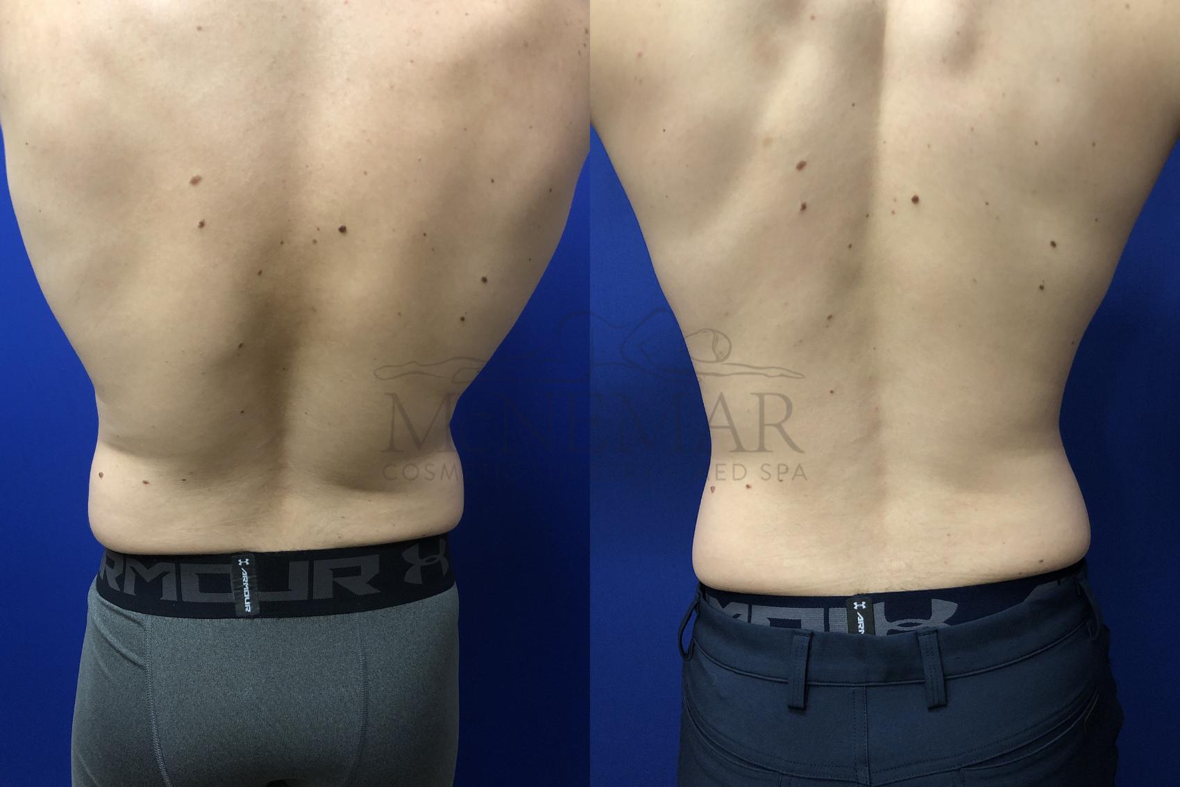 Liposuction Case 135 Before & After Back | Tracy, Brentwood & Livermore, CA | McNemar Cosmetic Surgery