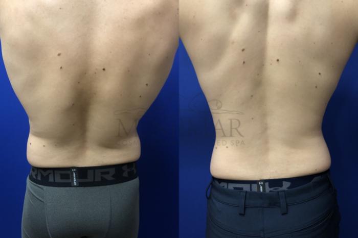 Liposuction Case 135 Before & After Back | San Ramon & Tracy, CA | McNemar Cosmetic Surgery