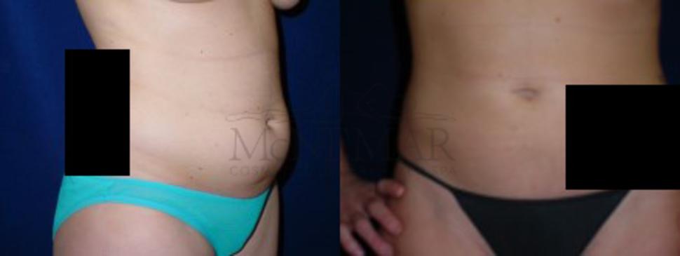 Liposuction Case 14 Before & After View #1 | San Ramon & Tracy, CA | McNemar Cosmetic Surgery