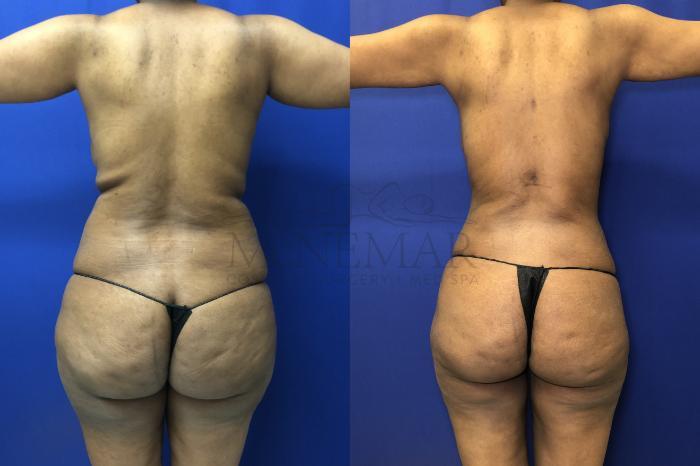 Liposuction Case 175 Before & After Back | Tracy, Brentwood & Livermore, CA | McNemar Cosmetic Surgery