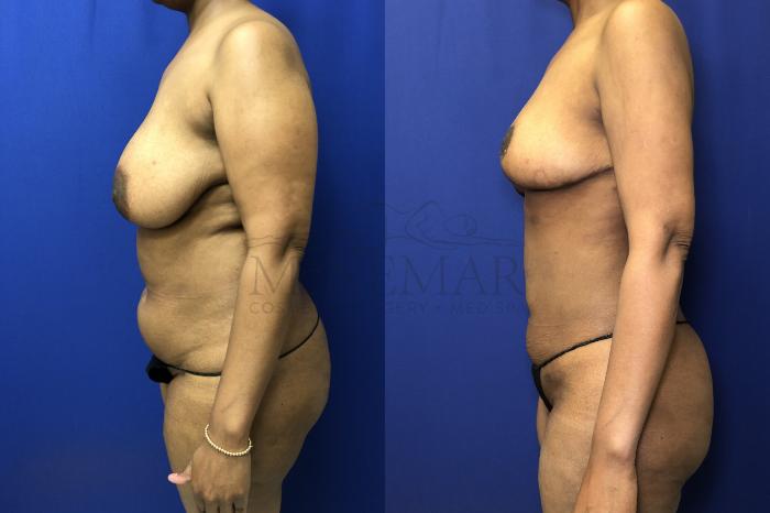 Liposuction Case 175 Before & After Left Side | Tracy, Brentwood & Livermore, CA | McNemar Cosmetic Surgery