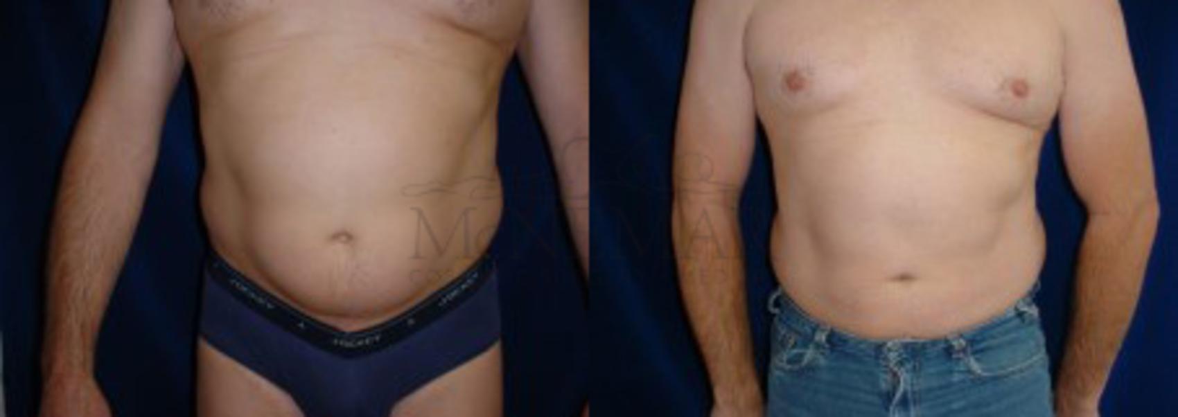 Vaser Liposuction Recovery