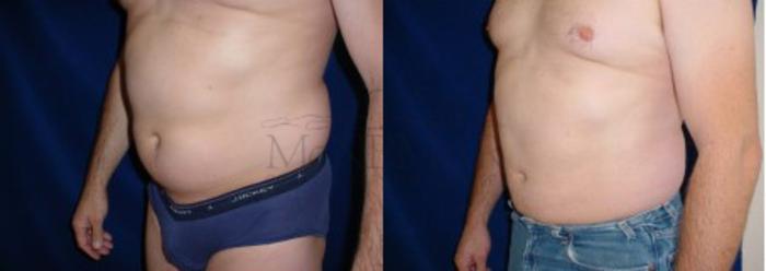 Liposuction Case 21 Before & After View #2 | San Ramon & Tracy, CA | McNemar Cosmetic Surgery