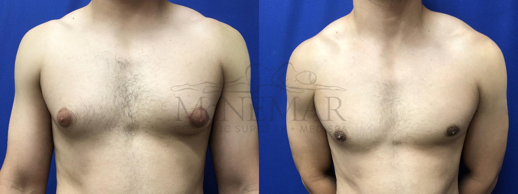 Male Breast Reduction Case 196 Before & After Front | Tracy, Brentwood & Livermore, CA | McNemar Cosmetic Surgery