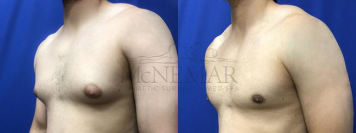 Male Breast Reduction Case 196 Before & After Left Side | Tracy, Brentwood & Livermore, CA | McNemar Cosmetic Surgery