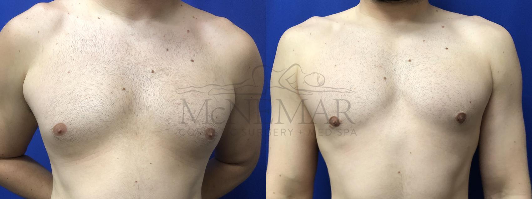 Male Breast Reduction Case 202 Before & After Front | Tracy, Brentwood & Livermore, CA | McNemar Cosmetic Surgery