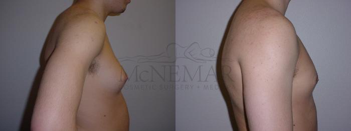 Male Breast Reduction Case 94 Before & After View #2 | Tracy, Brentwood & Livermore, CA | McNemar Cosmetic Surgery