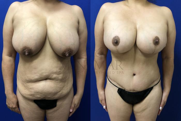 Breast Augmentation Case 149 Before & After Front | San Ramon & Tracy, CA | McNemar Cosmetic Surgery