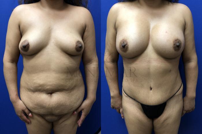 Breast Augmentation Case 150 Before & After Front | San Ramon & Tracy, CA | McNemar Cosmetic Surgery