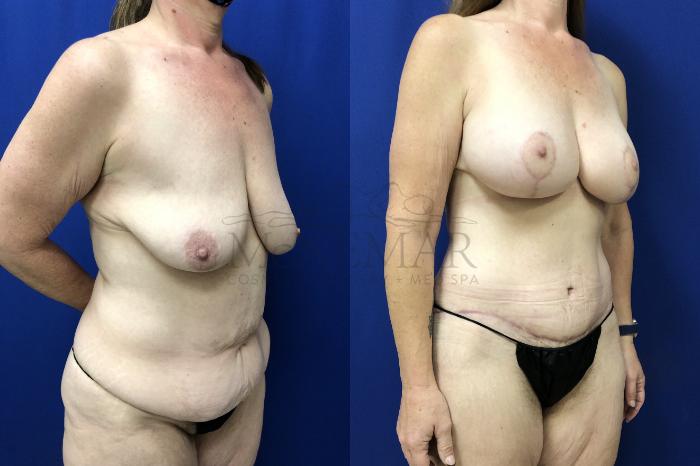 Breast Augmentation Case 154 Before & After Left Oblique | Tracy, Brentwood & Livermore, CA | McNemar Cosmetic Surgery