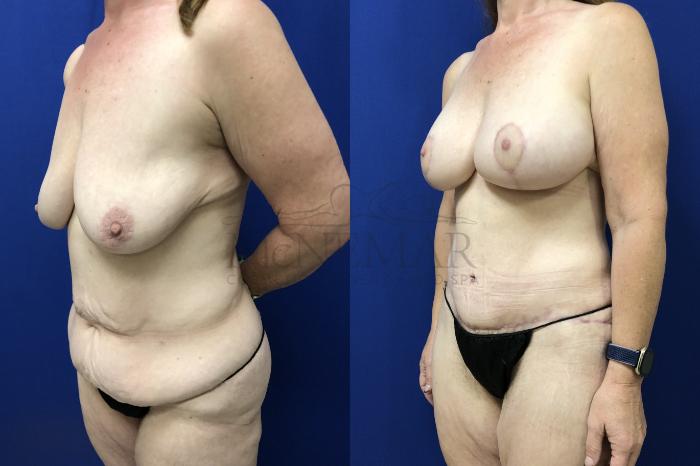 Breast Lift (Mastopexy) Case 154 Before & After Right Oblique | Tracy, Brentwood & Livermore, CA | McNemar Cosmetic Surgery