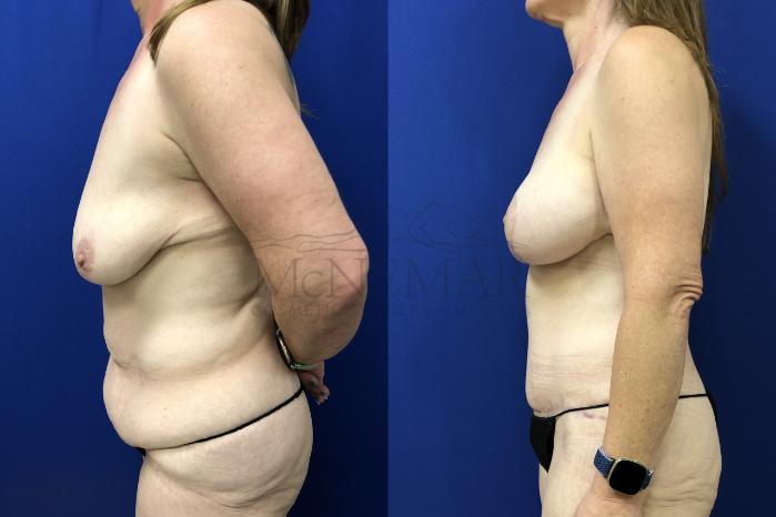 Breast Augmentation Case 154 Before & After Right Side | Tracy, Brentwood & Livermore, CA | McNemar Cosmetic Surgery