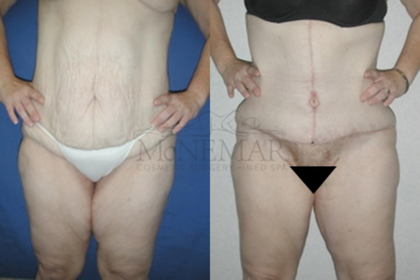 Thigh Lift Case 55 Before & After View #2 | San Ramon & Tracy, CA | McNemar Cosmetic Surgery