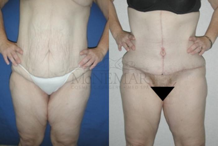 Thigh Lift Case 55 Before & After View #2 | Tracy, Brentwood & Livermore, CA | McNemar Cosmetic Surgery