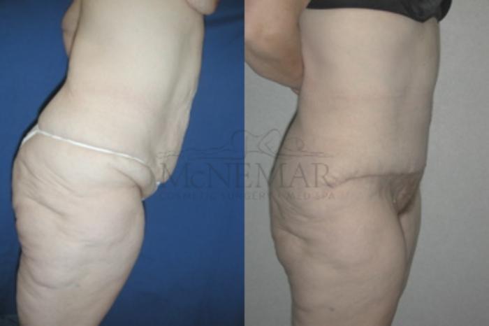 Thigh Lift Case 55 Before & After View #3 | Tracy, Brentwood & Livermore, CA | McNemar Cosmetic Surgery