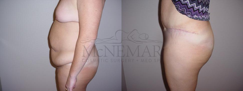 Tummy Tuck (Abdominoplasty) Case 102 Before & After View #2 | San Ramon & Tracy, CA | McNemar Cosmetic Surgery