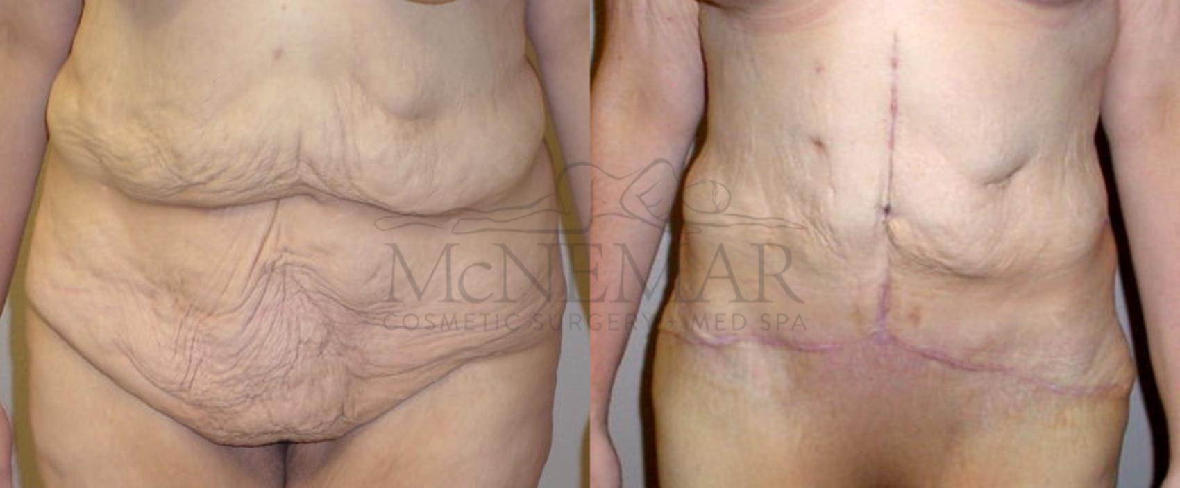 Tummy Tuck (Abdominoplasty) Case 105 Before & After View #1 | San Ramon & Tracy, CA | McNemar Cosmetic Surgery