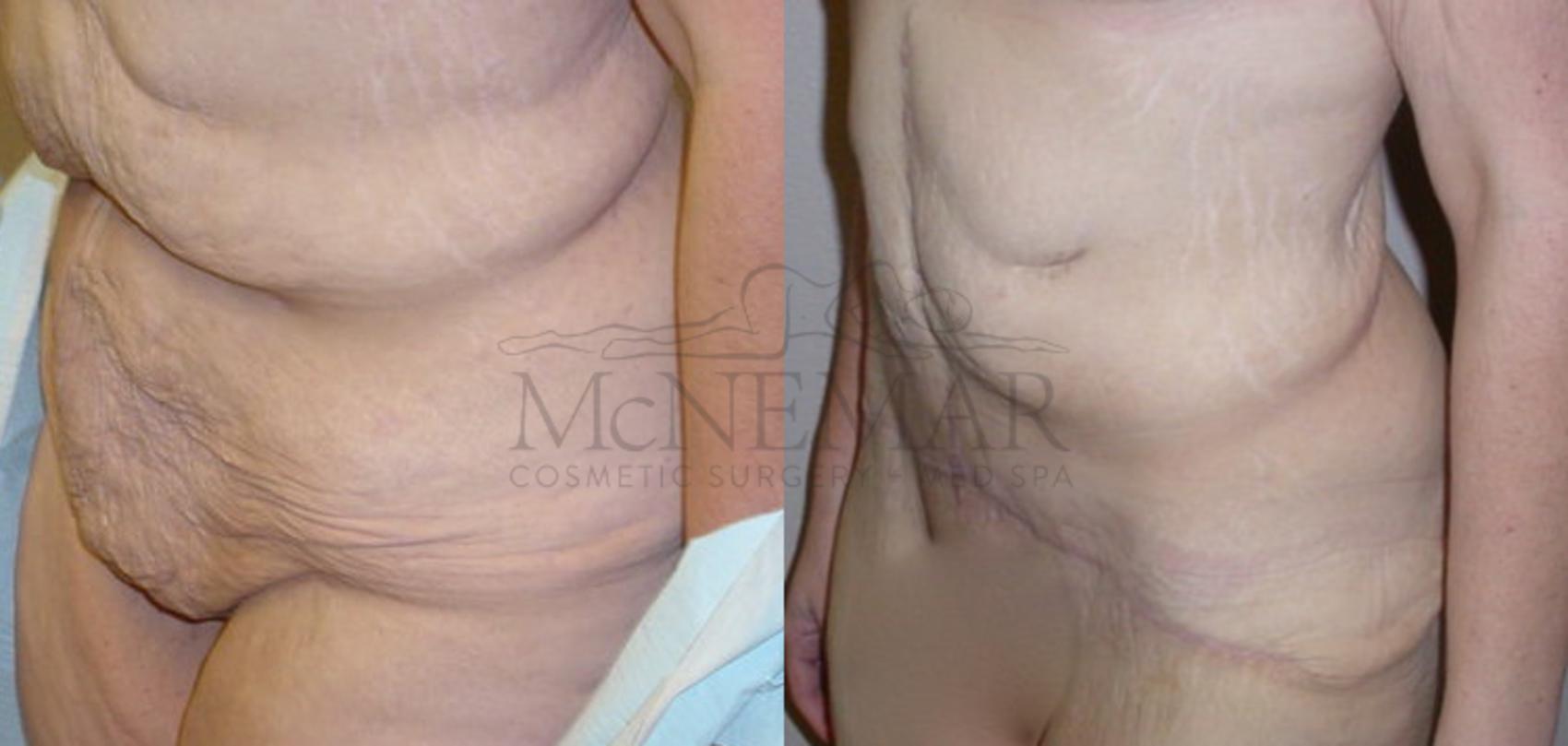 Tummy Tuck (Abdominoplasty) Case 105 Before & After View #2 | San Ramon & Tracy, CA | McNemar Cosmetic Surgery