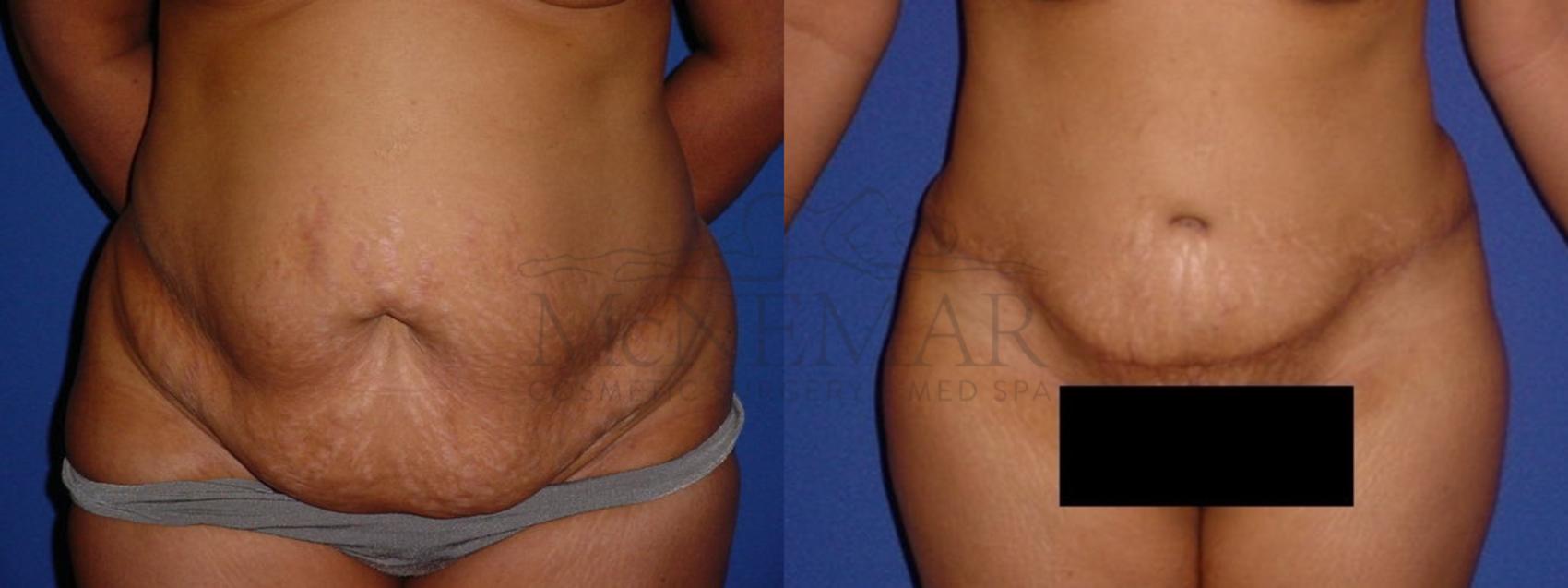 Tummy Tuck (Abdominoplasty) Case 112 Before & After View #1 | San Ramon & Tracy, CA | McNemar Cosmetic Surgery