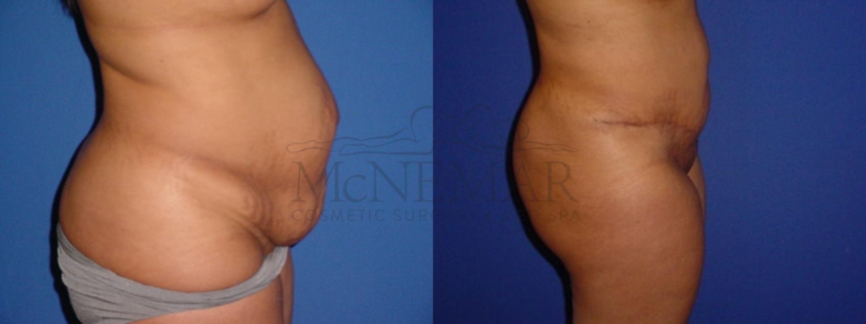Tummy Tuck (Abdominoplasty) Case 112 Before & After View #2 | San Ramon & Tracy, CA | McNemar Cosmetic Surgery
