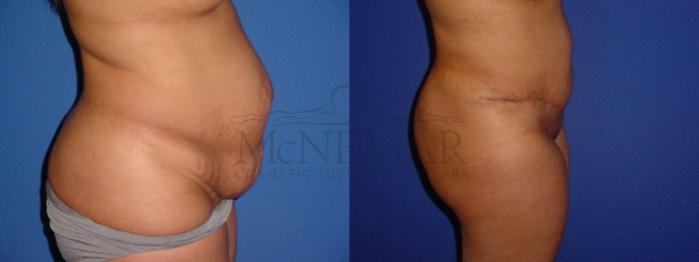 Tummy Tuck (Abdominoplasty) Case 112 Before & After View #2 | Tracy, Brentwood & Livermore, CA | McNemar Cosmetic Surgery