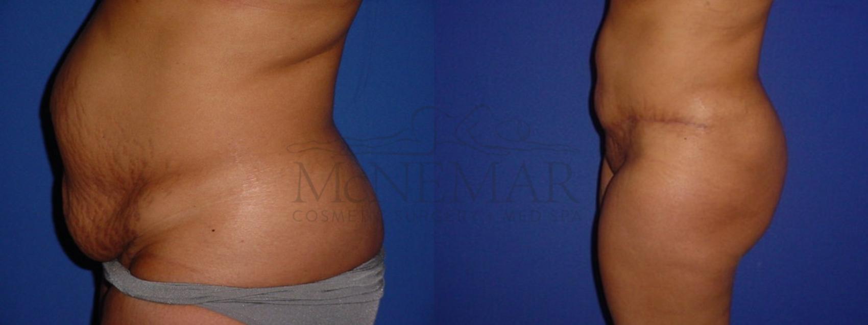 Tummy Tuck (Abdominoplasty) Case 112 Before & After View #3 | San Ramon & Tracy, CA | McNemar Cosmetic Surgery