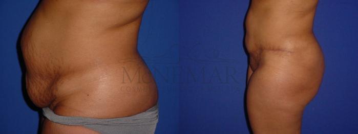 Tummy Tuck (Abdominoplasty) Case 112 Before & After View #3 | Tracy, Brentwood & Livermore, CA | McNemar Cosmetic Surgery