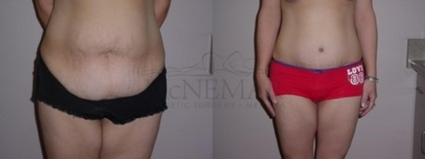 Tummy Tuck (Abdominoplasty) Case 114 Before & After Front | San Ramon & Tracy, CA | McNemar Cosmetic Surgery