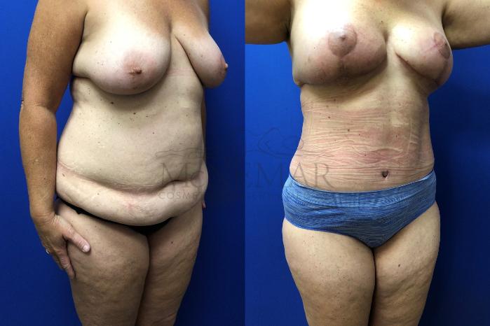 Tummy Tuck on a 55 year old female patient.