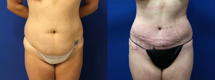 Tummy Tuck (Abdominoplasty) Case 126 Before & After Front | Tracy, Brentwood & Livermore, CA | McNemar Cosmetic Surgery