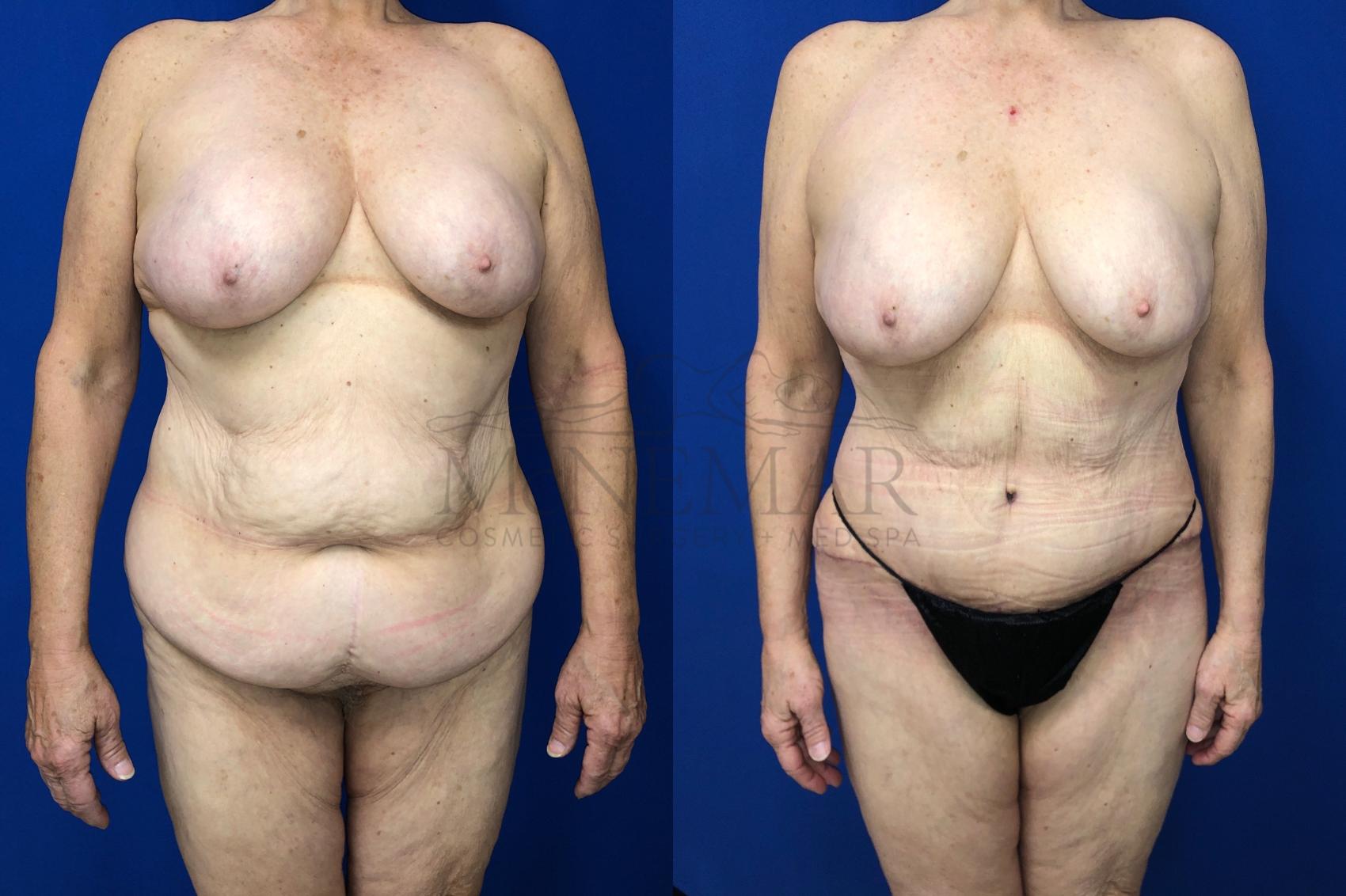 Tummy Tuck (Abdominoplasty) Case 129 Before & After Front | San Ramon & Tracy, CA | McNemar Cosmetic Surgery