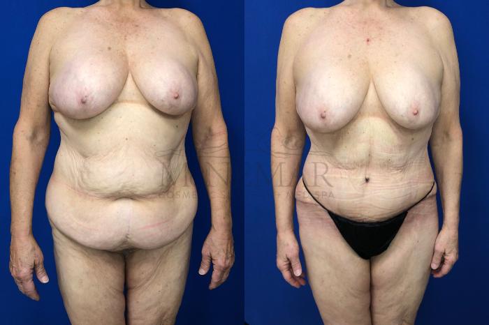 Tummy Tuck (Abdominoplasty) Case 129 Before & After Front | Tracy, Brentwood & Livermore, CA | McNemar Cosmetic Surgery