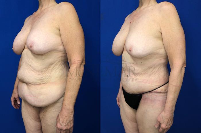 Tummy Tuck (Abdominoplasty) Case 129 Before & After Right Side | Tracy, Brentwood & Livermore, CA | McNemar Cosmetic Surgery