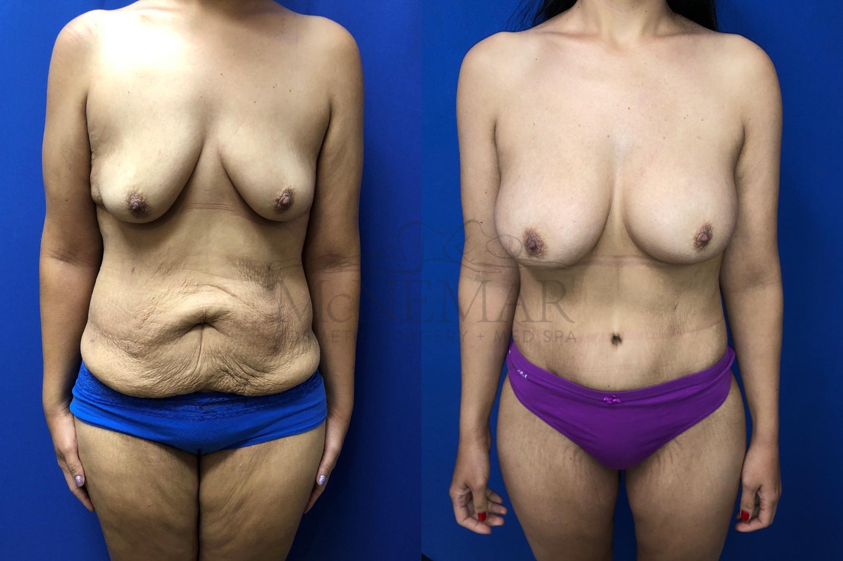 Tummy Tuck (Abdominoplasty) Case 131 Before & After Front | Tracy, Brentwood & Livermore, CA | McNemar Cosmetic Surgery