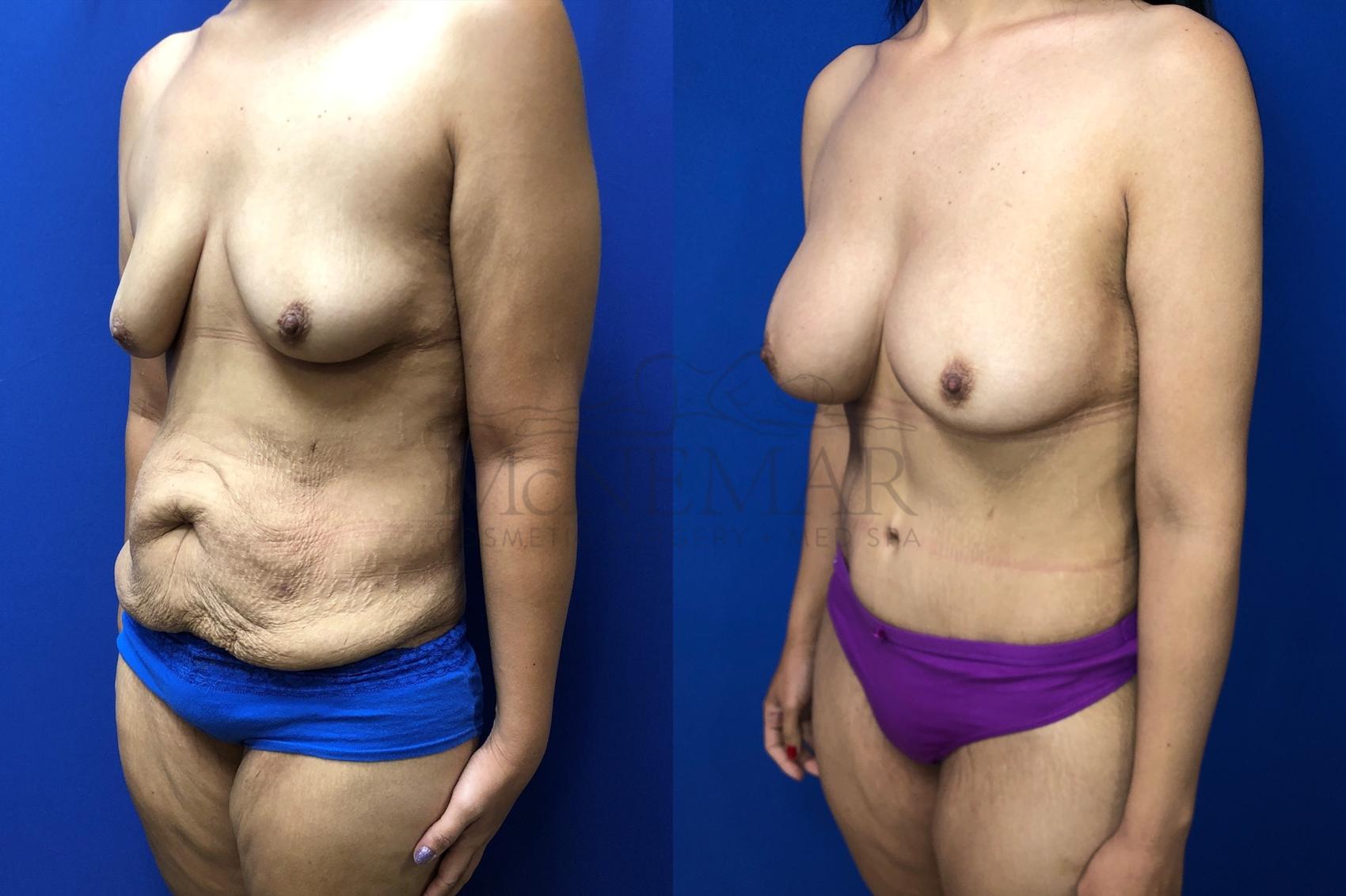 Tummy Tuck (Abdominoplasty) Case 131 Before & After Right Oblique | San Ramon & Tracy, CA | McNemar Cosmetic Surgery