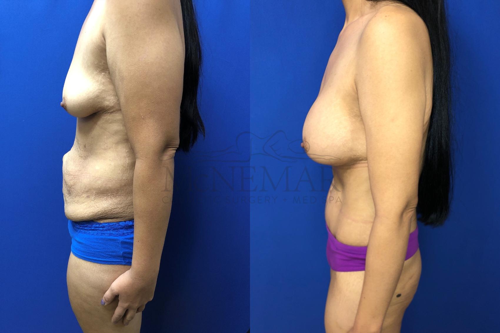 Tummy Tuck (Abdominoplasty) Case 131 Before & After Right Side | San Ramon & Tracy, CA | McNemar Cosmetic Surgery