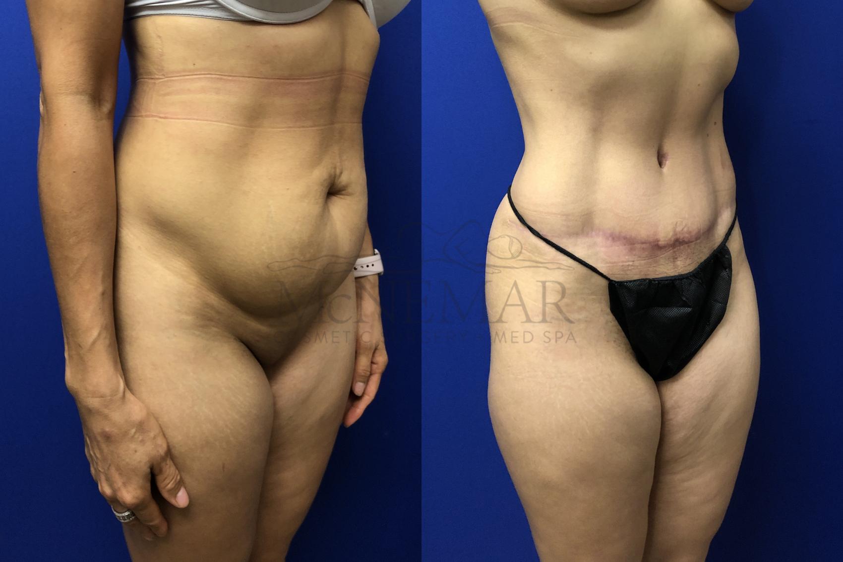 Tummy Tuck (Abdominoplasty) Case 139 Before & After Left Oblique | San Ramon & Tracy, CA | McNemar Cosmetic Surgery