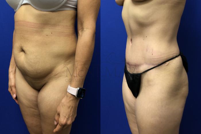 Tummy Tuck (Abdominoplasty) Case 139 Before & After Right Oblique | San Ramon & Tracy, CA | McNemar Cosmetic Surgery