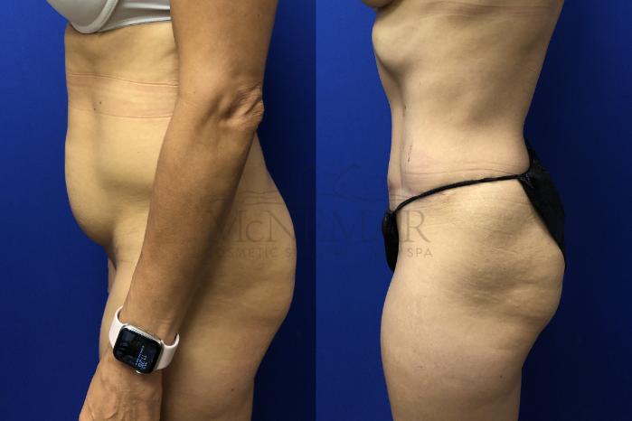 Tummy Tuck (Abdominoplasty) Case 139 Before & After Right Side | San Ramon & Tracy, CA | McNemar Cosmetic Surgery